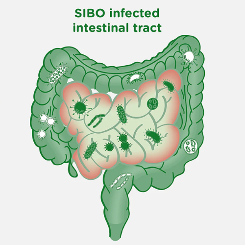 Gut Dysbiosis and SIBO