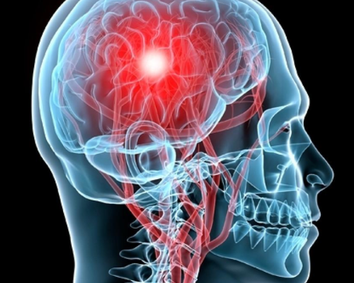 Gut Dysbiosis and Concussions