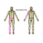 neuropathic pain