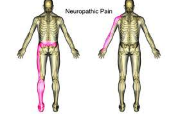 Neuropathic Pain