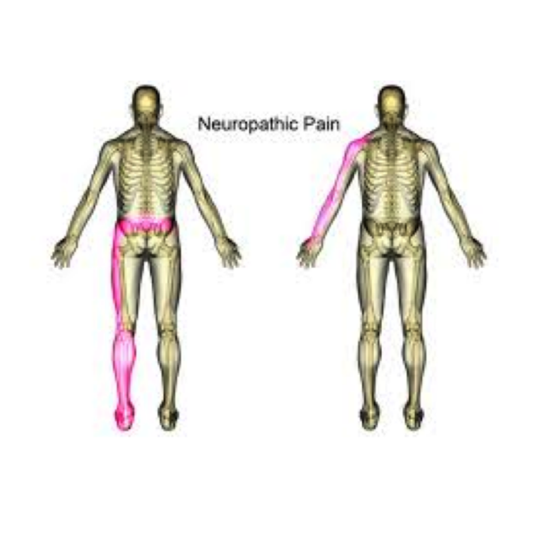 Neuropathic Pain